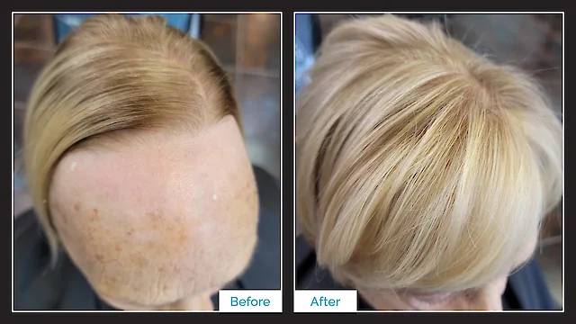 Toupee Hair Replacement - Before & After - By Kristan Sayers