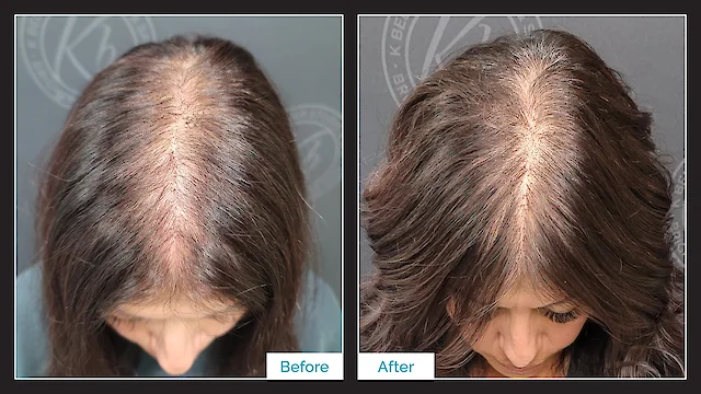 Micro Point Non-Surgical Hair Replacement