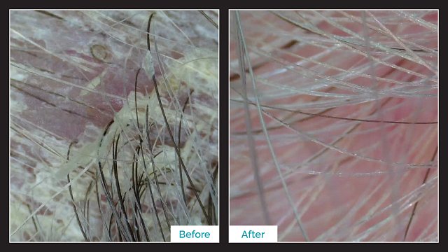 Before & After Seborrheic Dermatitis